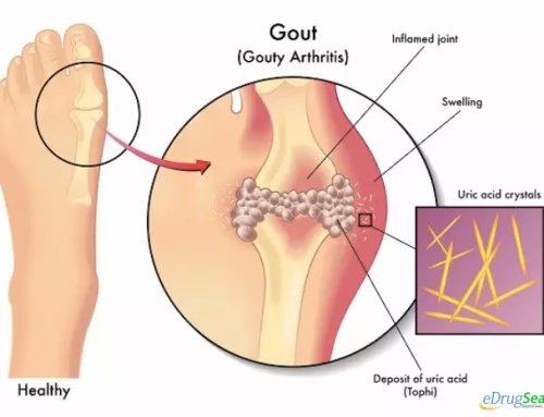 Prevention and Home Remedies for Gout