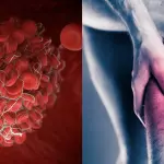 Blood Clots: A Frequent Killer You Might Be Ignoring