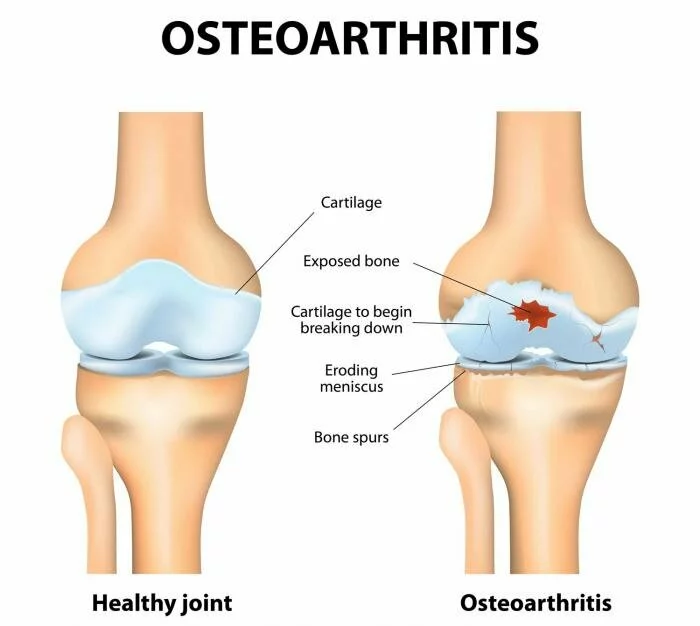 Osteoarthritis Medications