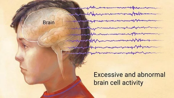 Epilepsy and Anti-Seizure Medications
