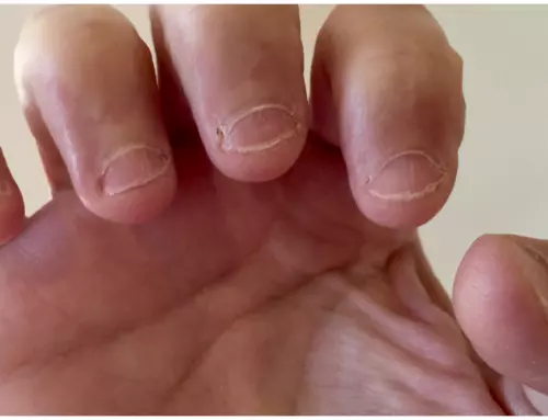 University Releases Study That Explains Personality Trait of People Who Bite Their Nails