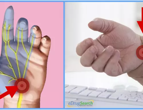 8 Home Remedies for Carpal Tunnel Syndrome You Need to Try