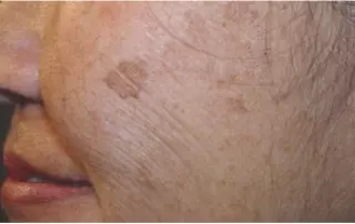age spot removal