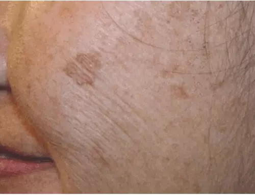 This 2-Ingredient Trick for Getting Rid of Age Spots Will Make You Look Young Again