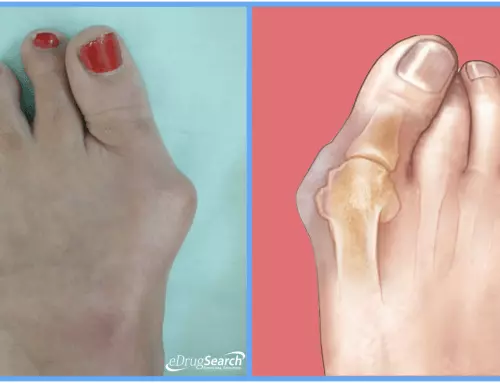 Painful Bumps on the Side of Your Feet Can Be Managed with This Bunion Treatment