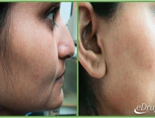 Does Vaniqa Really Remove Unwanted Facial Hair?